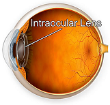 Mature Cataract