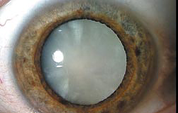 Mature Cataract